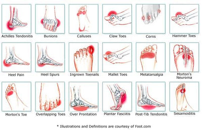 Breaking down a broken down foot